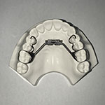 palatal expander