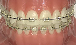 gold braces